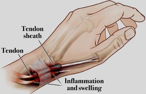 腱鞘炎：手部和足部炎症