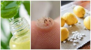 六種強力除疣配方