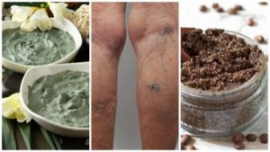 天然配方擺脫靜脈曲張