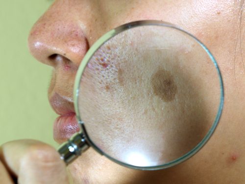 臉部曬斑的七種治療方法