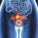 無聲的疾病--子宮內膜異位症的風險和症狀