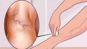 治療靜脈曲張的八種運動