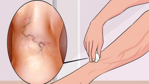 治療靜脈曲張的八種運動