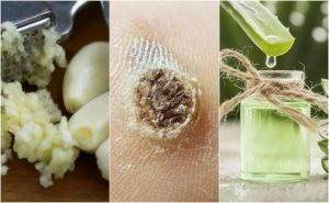 強力推薦5種天然除疣療法