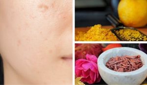 如何治療黑斑暗沉