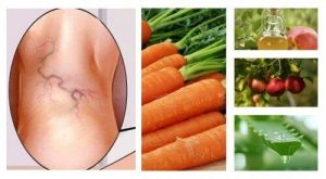 三種天然成份治療靜脈曲張