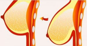 八個拯救乳房下垂的方法