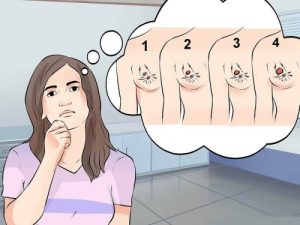 乳癌的種類、症狀和治療