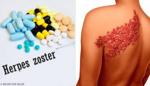 帶狀皰疹的症狀和診斷