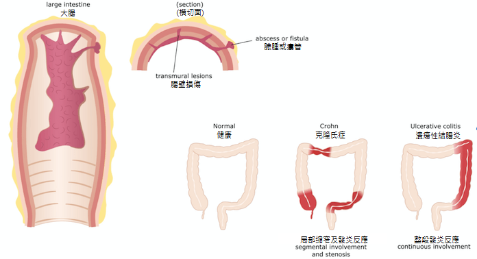 克隆氏症1(中文化)