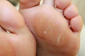 手腳上磨出厚皮、老繭? 4種方法讓你的皮膚汰舊換新