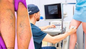 靜脈曲張的天然外用及口服療法