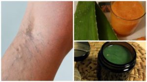 治療靜脈曲張的阿嬤秘方