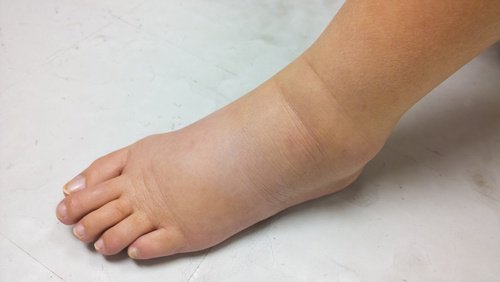 腫脹