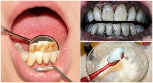 3招自然療法清除牙菌斑