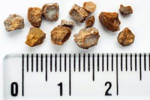 對抗腎結石的六份健康食譜