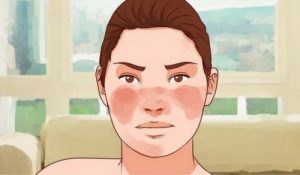 抑制狼瘡的七種自然療法