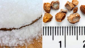 擺脫腎結石的七種居家療法