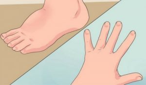 五種減少水腫的簡單方法