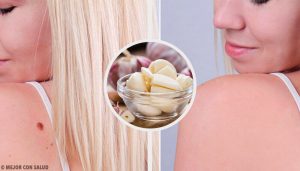 九種快速除疣的方法