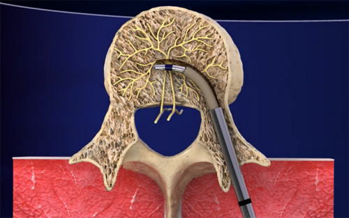INTRACEPT