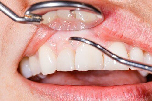 七種緩解牙齦腫脹的自然療法
