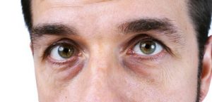 消除黑眼圈的四種自然療法