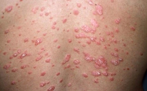 什麼是乾癬?有哪些不同症狀？