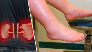 水腫的原因是什麼?