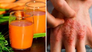 七種預防及對抗乾癬的自然療法