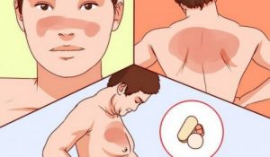 關於狼瘡你該知道些什麼?