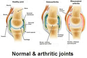 區分關節炎、骨關節炎和骨質疏鬆症