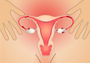 改善子宮內膜異位症的五種自然方法