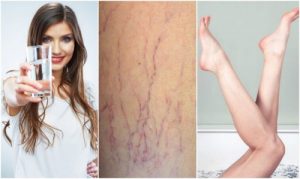 若想要預防靜脈曲張，請閱讀以下六招