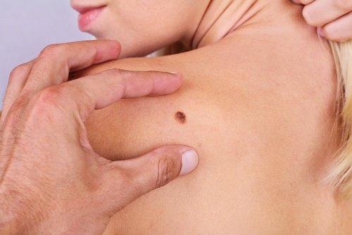 六種不能忽視的皮膚癌症狀