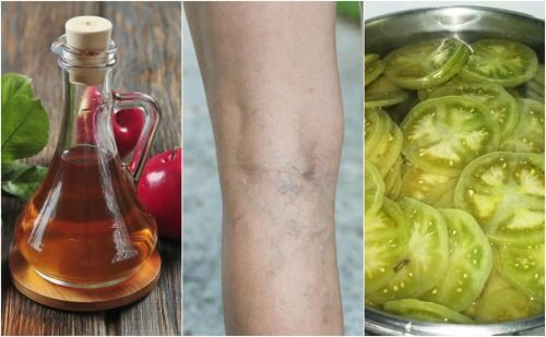 用醋和青蕃茄對抗靜脈曲張