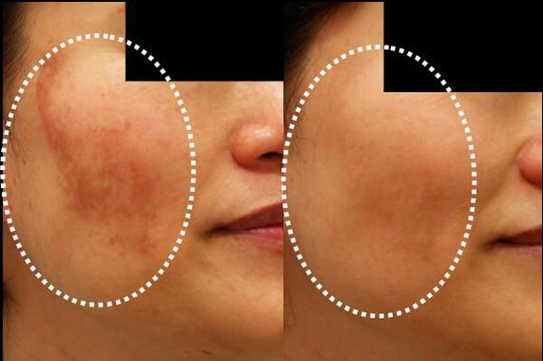 用這5種自製面膜減少皮膚變色