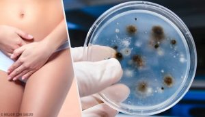 陰道感染的類型和原因