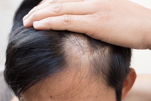 禿髮的6種自然療法