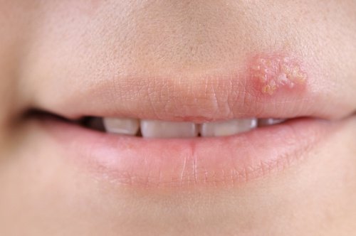 唇皰疹的五種居家療法