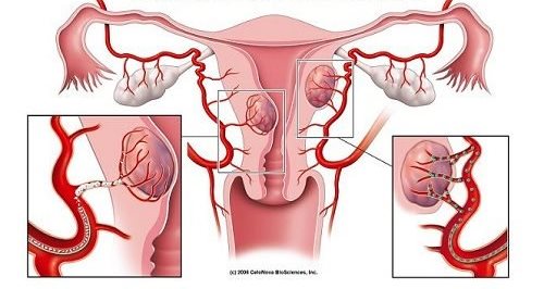 子宮肌瘤的七項警訊
