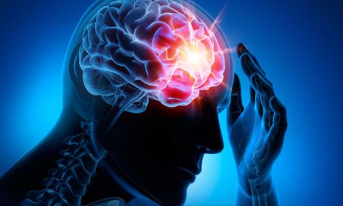 四種最常見的腦血管疾病
