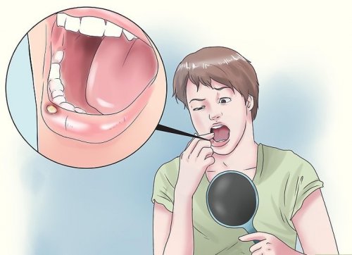 8種口腔潰瘍的天然療法
