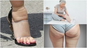 5種水腫的常見症狀