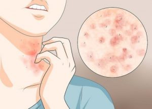 疥瘡的三種簡易家庭療法