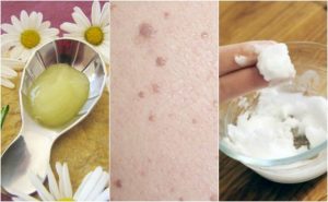 去除扁平疣的五種治療方法