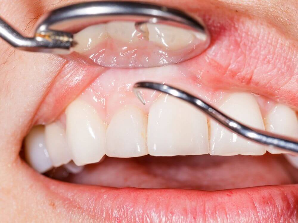 牙菌斑