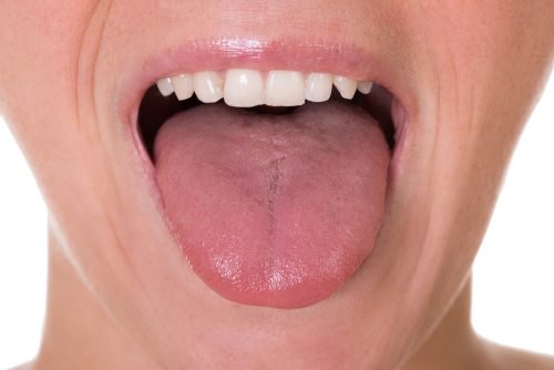 舌癌的五個主要症狀