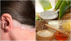 對付頭皮乾癬的5種居家療法