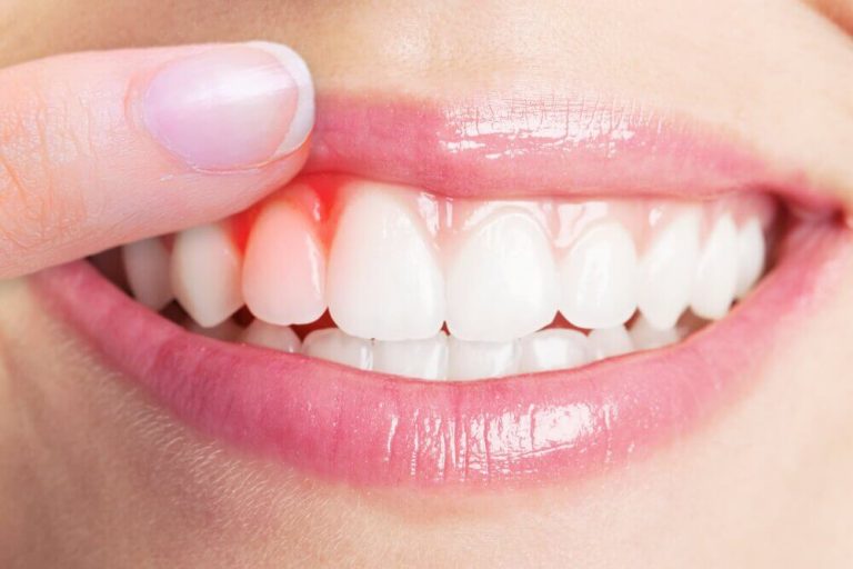治療牙齦炎最厲害的５種療法